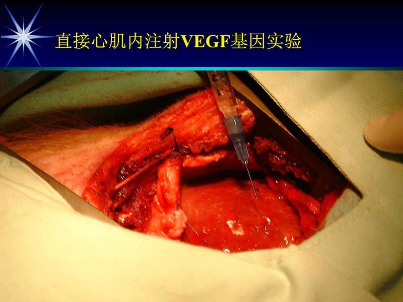 071719155638_01999-08-16激光基因心肌血运重建术_33.jpg