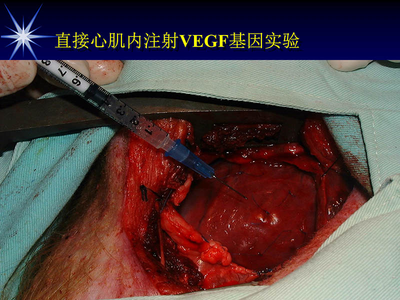 071719155638_01999-08-16激光基因心肌血运重建术_34.jpg