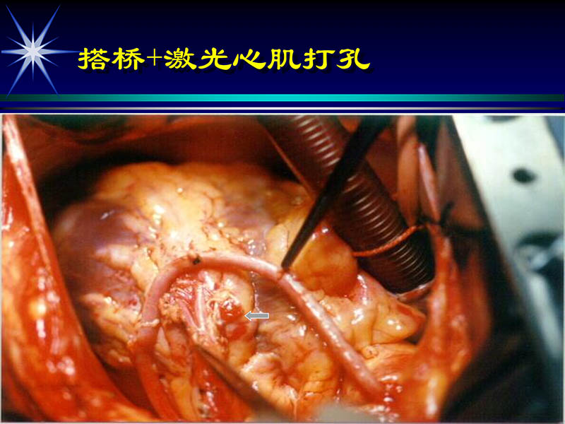 071719234773_02000-11-21激光在心脏外科的应用_23.jpg