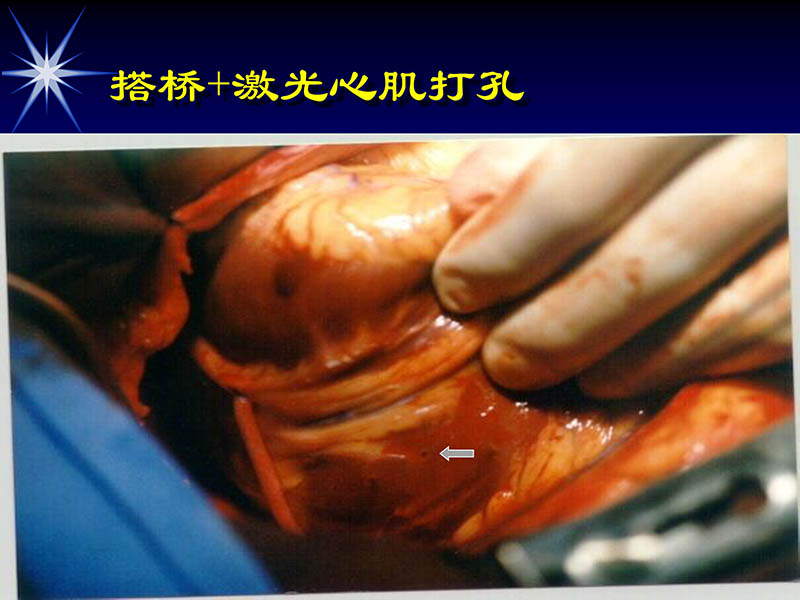 071719234773_02000-11-21激光在心脏外科的应用_24.jpg
