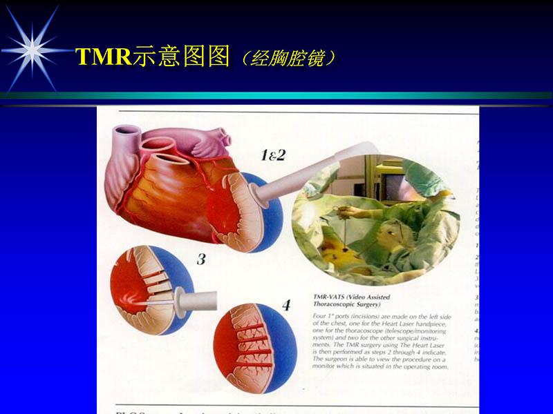071719234773_02000-11-21激光在心脏外科的应用_25.jpg
