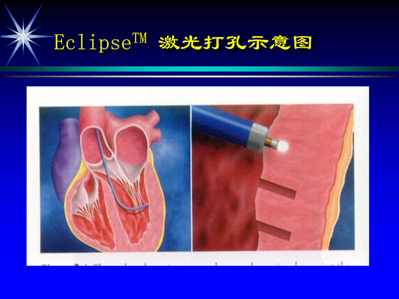 071813461818_02002-10-13激光在心血管疾病治疗中的应用_17.jpg