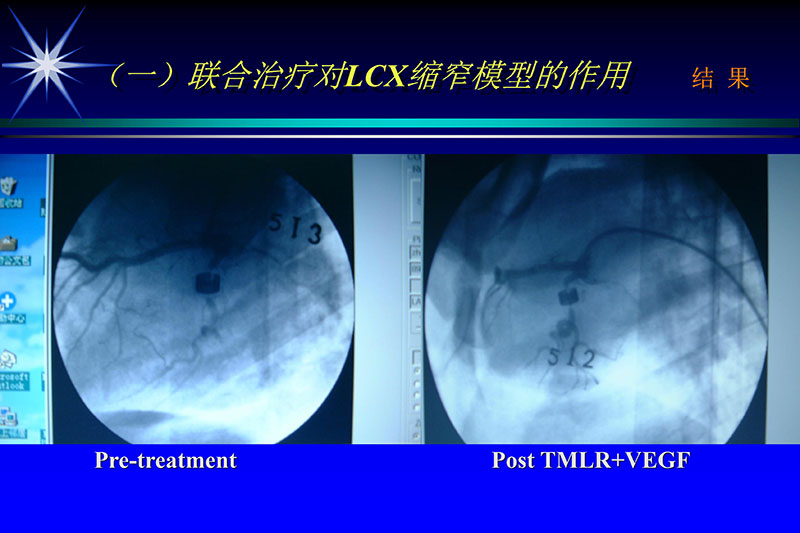071815272322_02003-12-30vegf基因联合激光心肌血运重建的研究_33.jpg