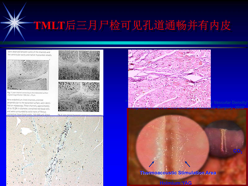 071815311003_02004-06-15激光直接心肌血运重建治疗冠心病_28.jpg