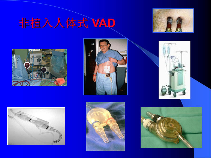 071816413472_02005-08-18现代人工心室装置治疗心衰临床应用_30.jpg