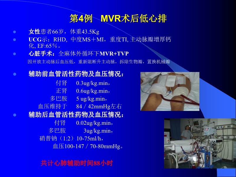 072010433259_02005-12-10机械辅助循环治疗围手术期心衰的临床体会_12.jpg