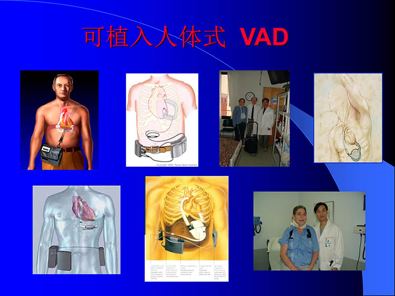 072010470242_02006-03-08人工心室装置治疗心衰临床应用新概念_19.jpg