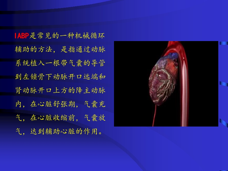 072812074688_02010-04-22主动脉内球囊反搏泵IABP的临床应用_4.jpg