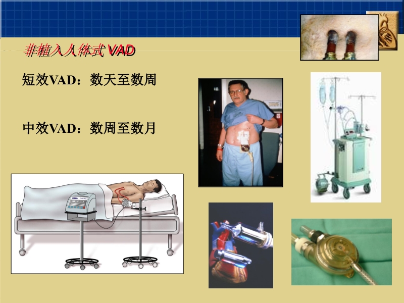 072812160890_02010-06-17心室辅助装置和人工心脏_7.jpg