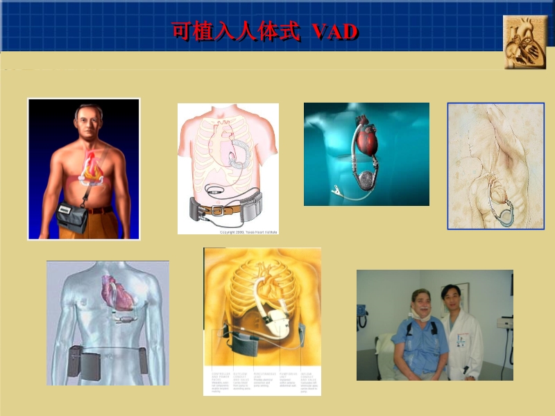 072812160890_02010-06-17心室辅助装置和人工心脏_15.jpg