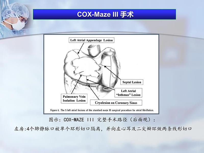 072812262445_02012-04-22微创外科治疗心房颤动_6.jpg
