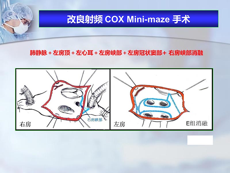 072812262445_02012-04-22微创外科治疗心房颤动_14.jpg
