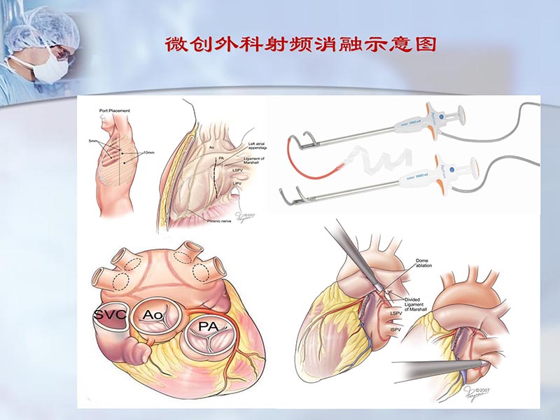 072812262445_02012-04-22微创外科治疗心房颤动_20.jpg