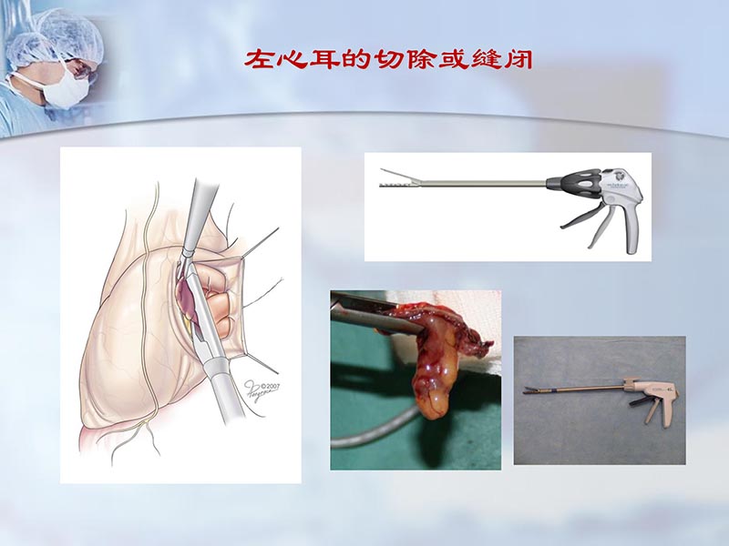 072812295126_02012-06-23外科治疗心房颤动的历史与现状_22.jpg