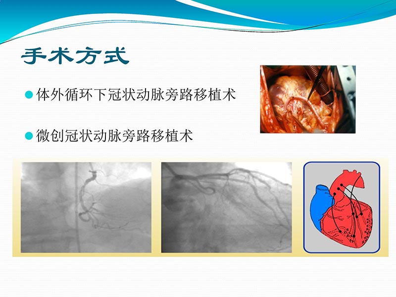 072813401993_02013-03-06微创冠状动脉搭桥治疗缺血性心脏病_14.jpg