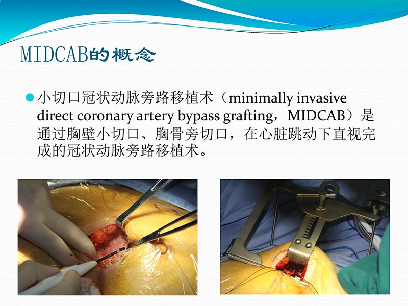 072813401993_02013-03-06微创冠状动脉搭桥治疗缺血性心脏病_34.jpg