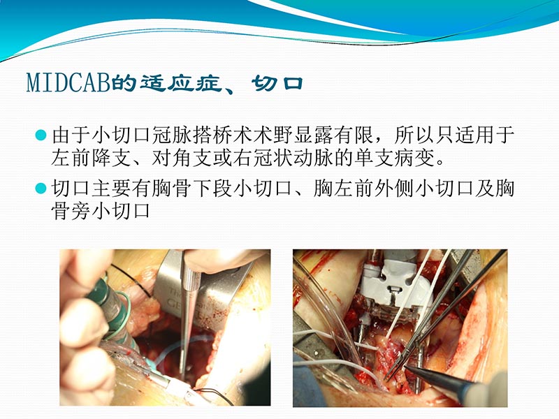 072813401993_02013-03-06微创冠状动脉搭桥治疗缺血性心脏病_35.jpg