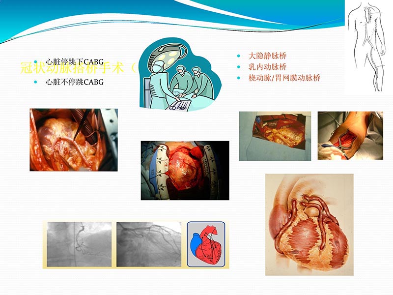 072813401993_02013-03-06微创冠状动脉搭桥治疗缺血性心脏病_67.jpg